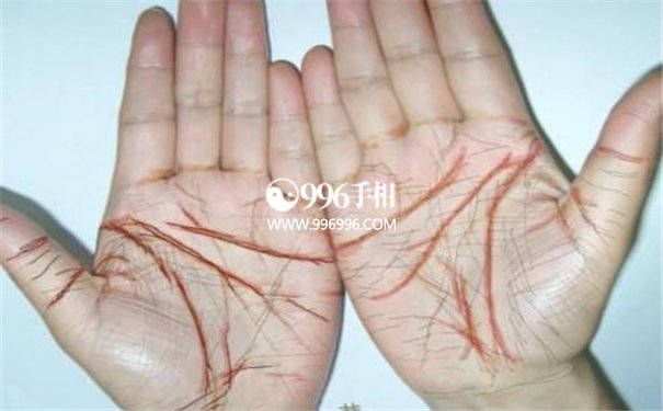 癌症手相肿瘤纹