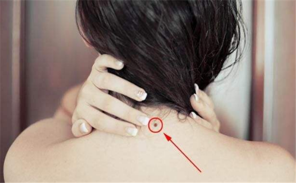 太阳穴上面长痣