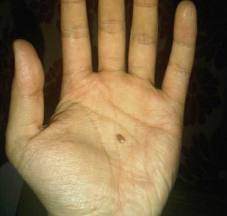 最有福分的10处胎记